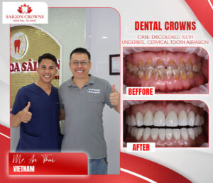 dental crowns before after 11