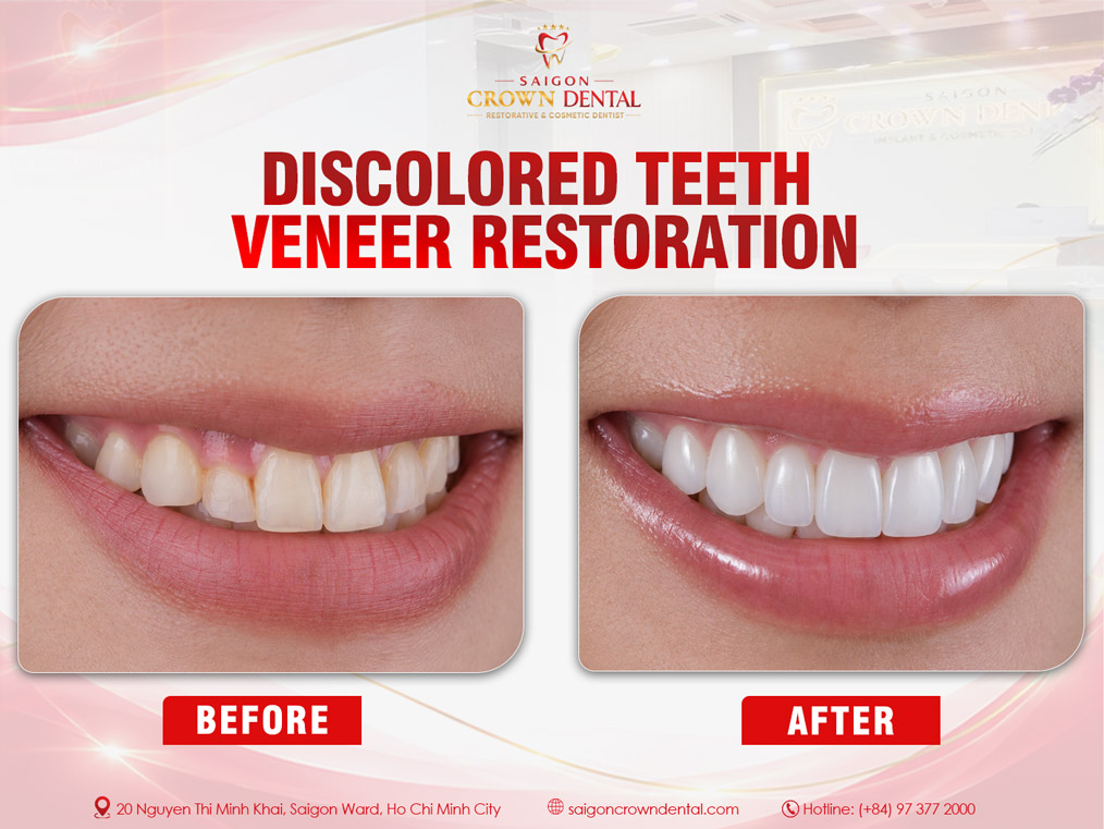 Heavily Discolored Teeth Veneer Restoration – Saigon Crown Dental