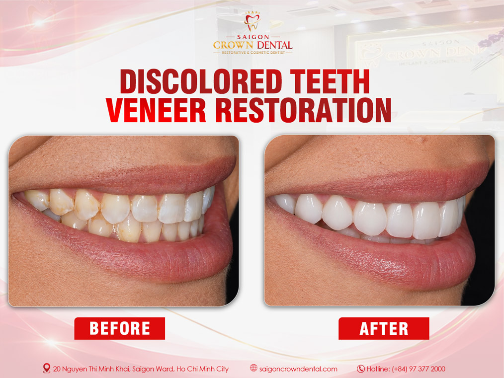 Yellow-Stained Teeth Veneer Restoration – Saigon Crown Dental