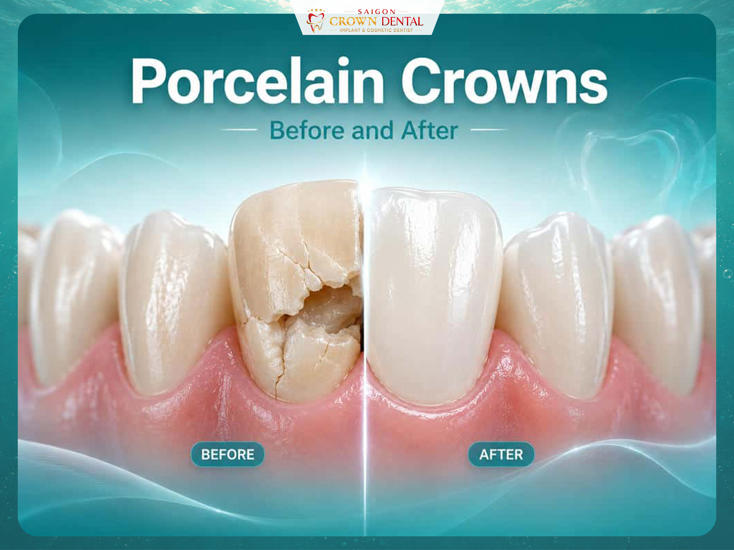 Porcelain crowns before and after