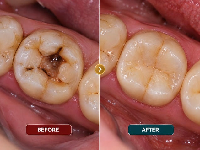 Root Canal Before & after