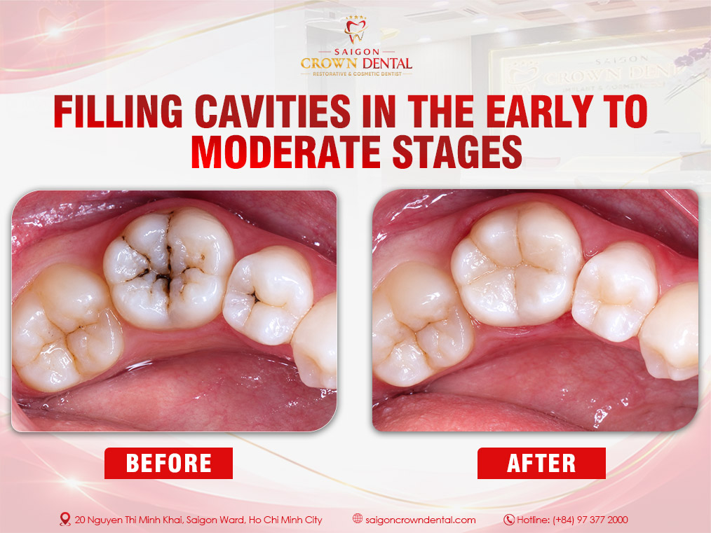 Filling small and medium-sized cavities