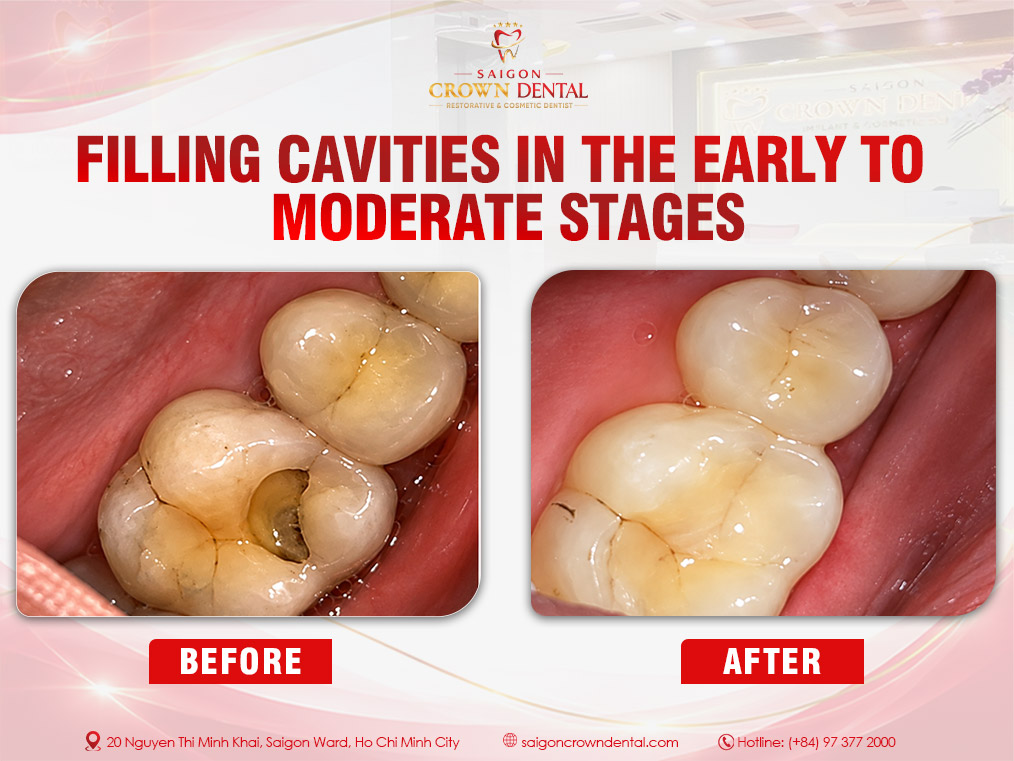 Filling small and medium-sized cavities