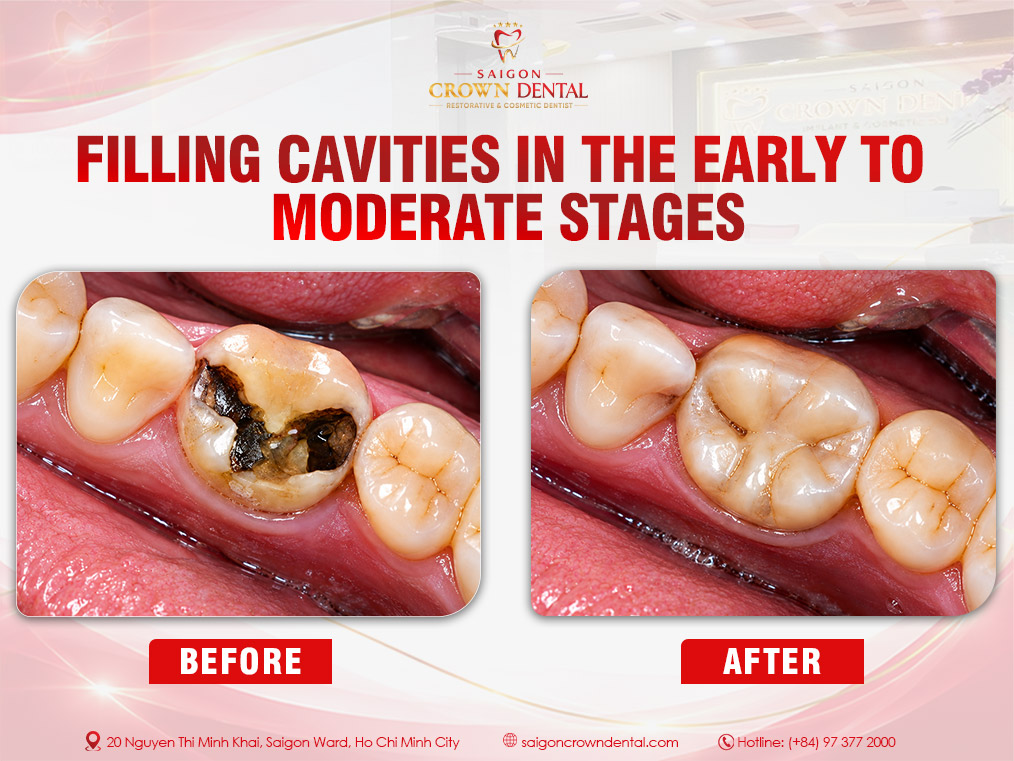 Filling small and medium-sized cavities