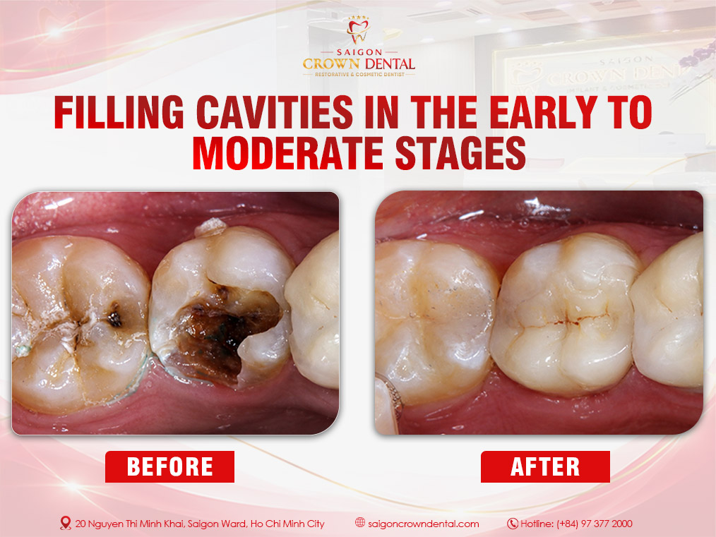 Filling small and medium-sized cavities