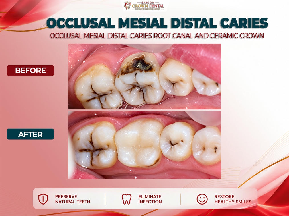 Root Canal Before & after