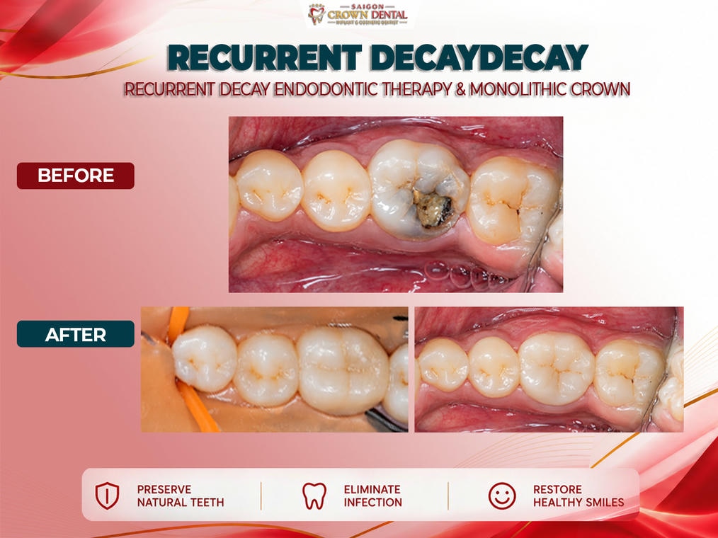 Root Canal Before & after