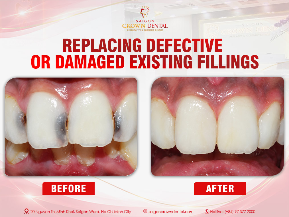 Replacing damaged existing filling