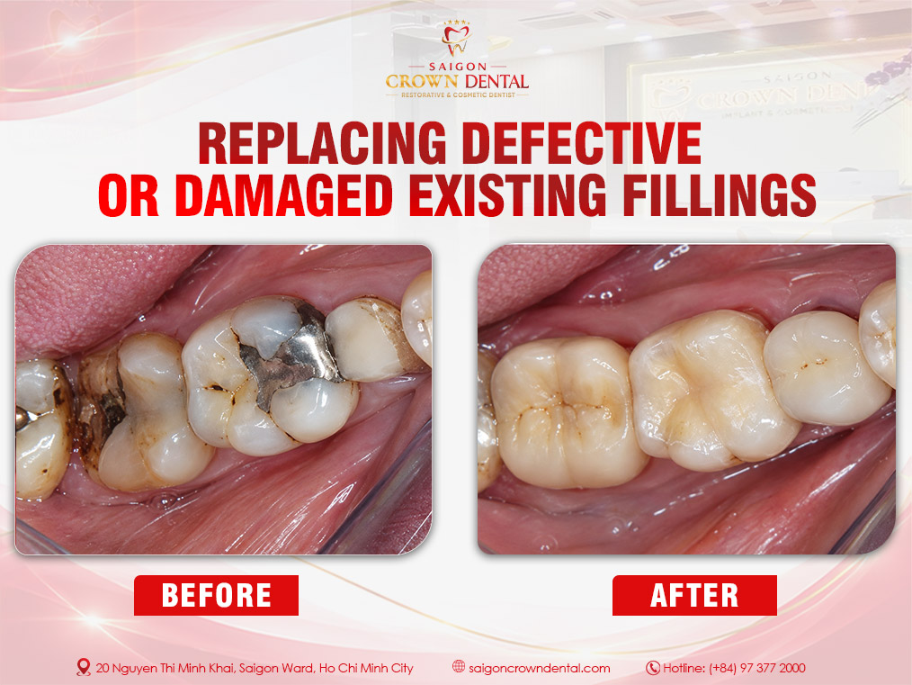 Replacing damaged existing filling