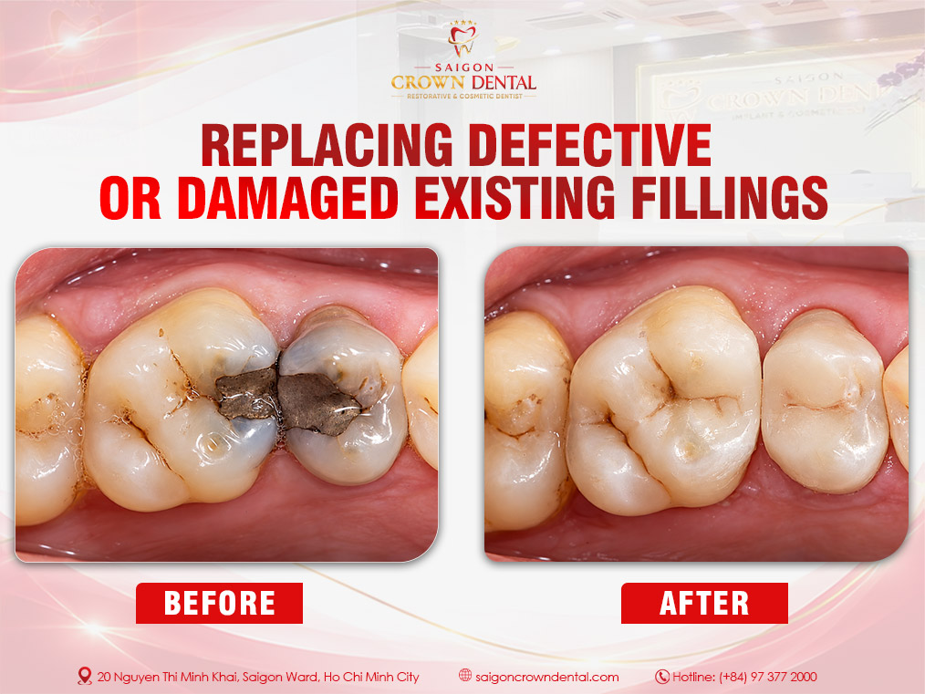 Replacing damaged existing filling