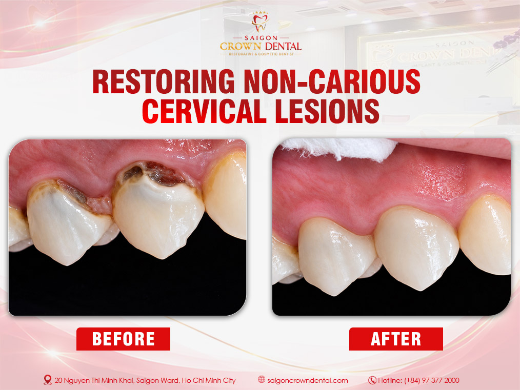 Restoring non-carious cervical lesions