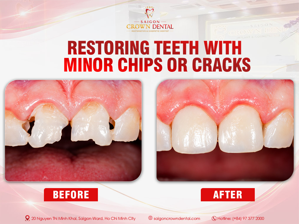 fillings teeth with minor chips or cracks