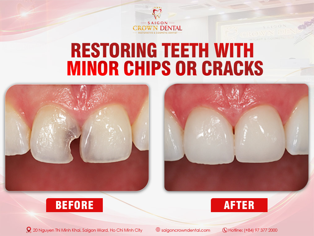 fillings teeth with minor chips or cracks