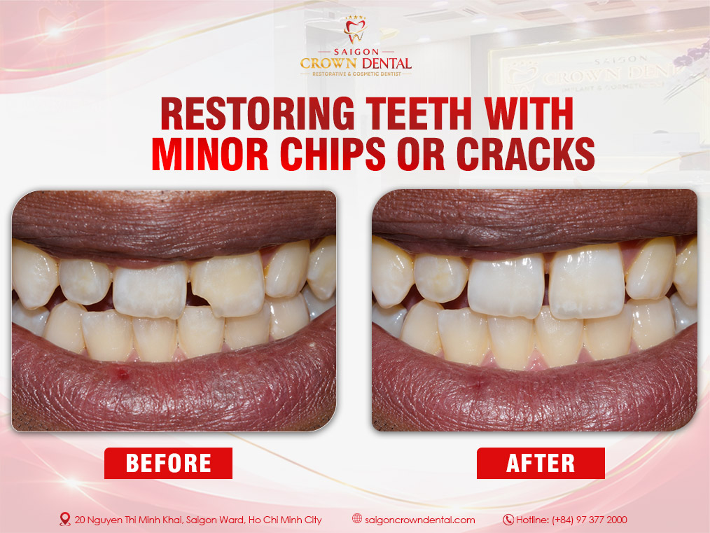 fillings teeth with minor chips or cracks