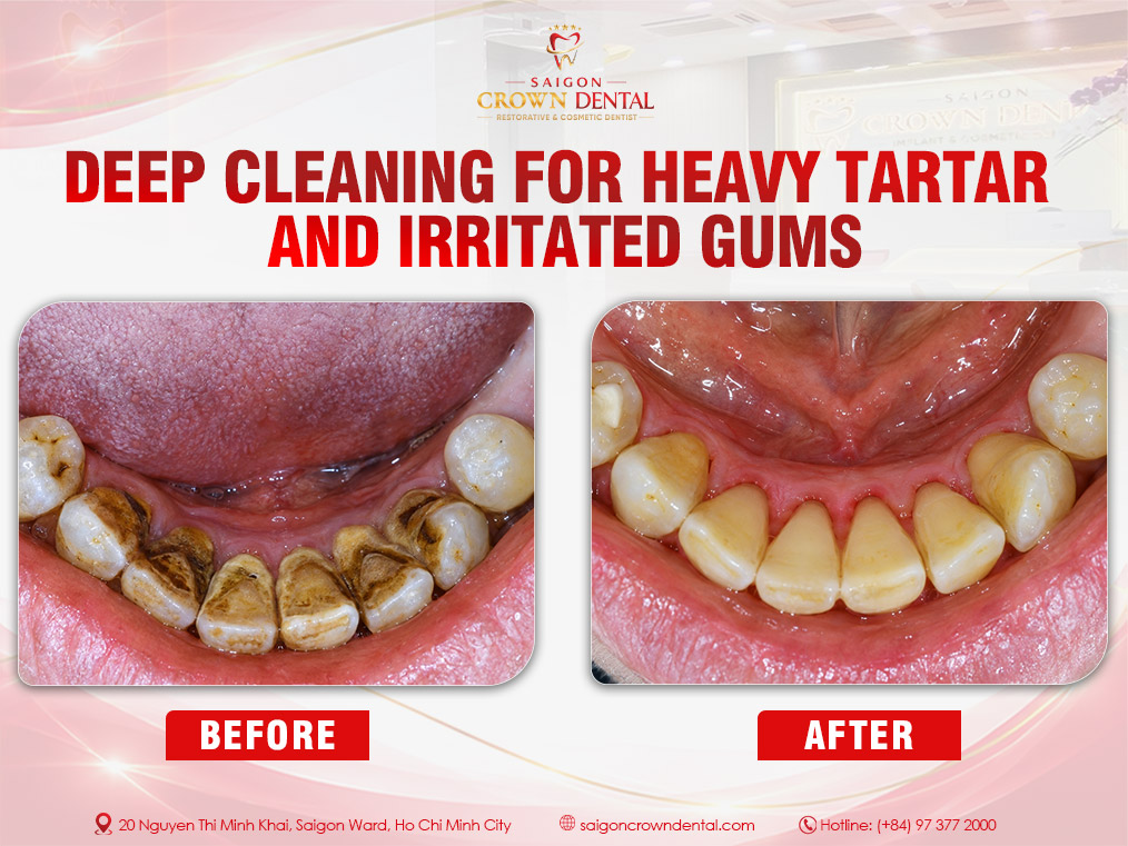 Teeth Cleaning Before and After