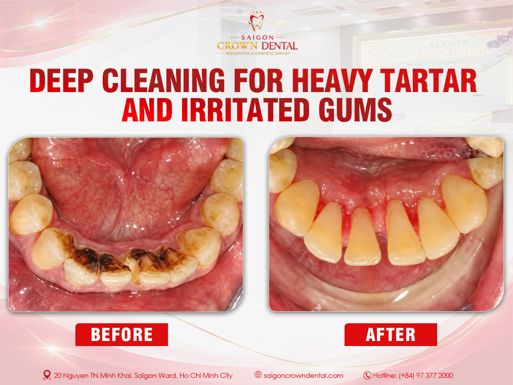 Teeth Cleaning Before and After