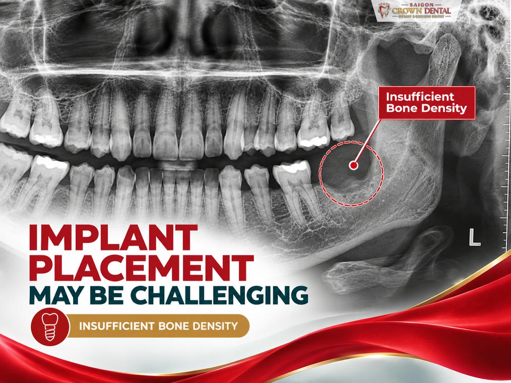 X-ray showing insufficient bone density for dental implant placement