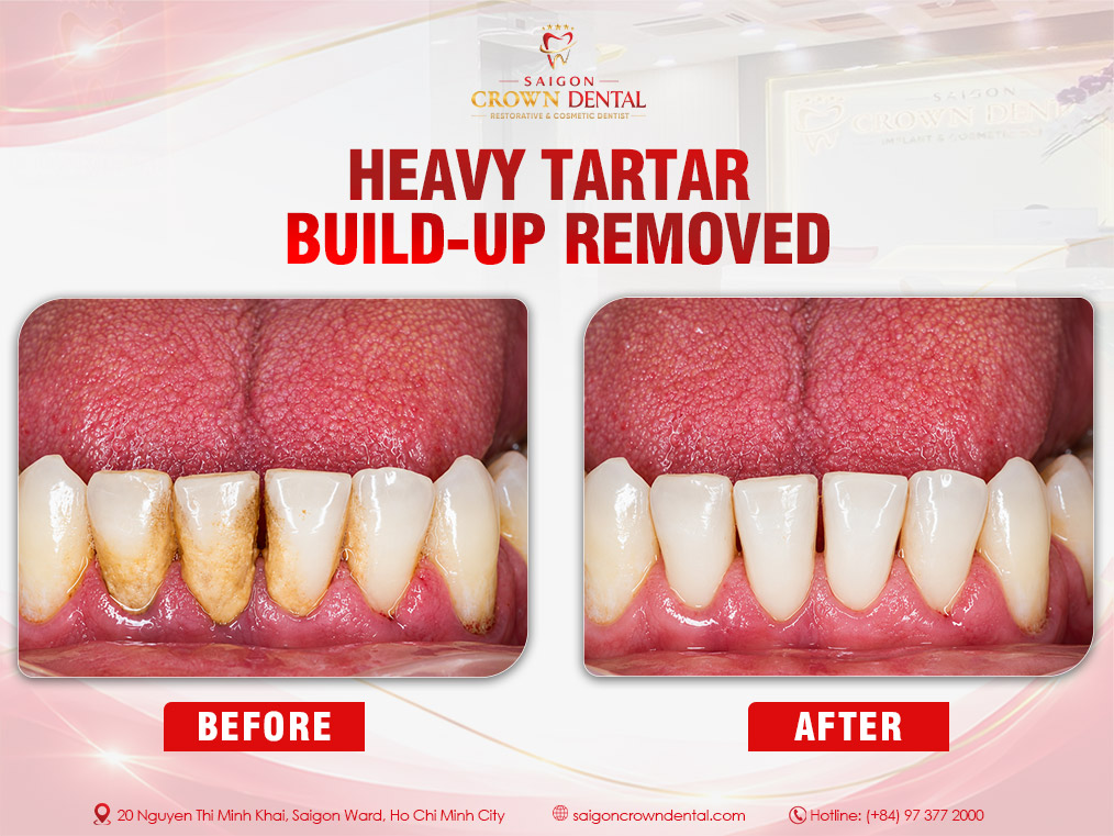 Teeth Cleaning Before and After