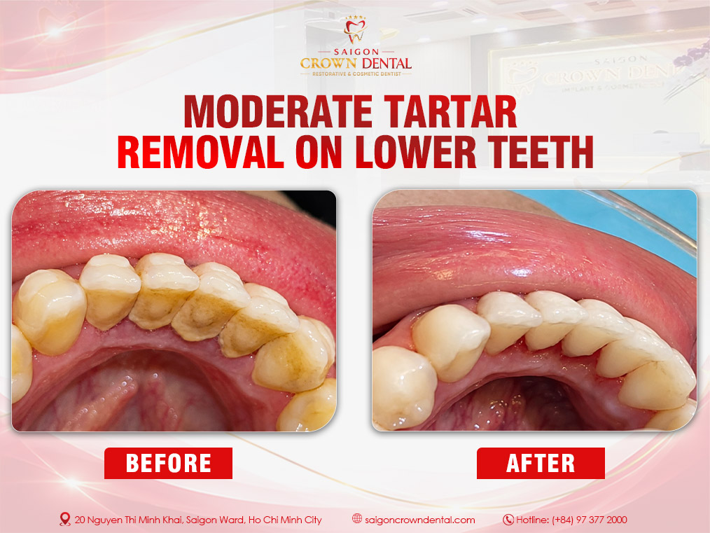 Teeth Cleaning Before and After
