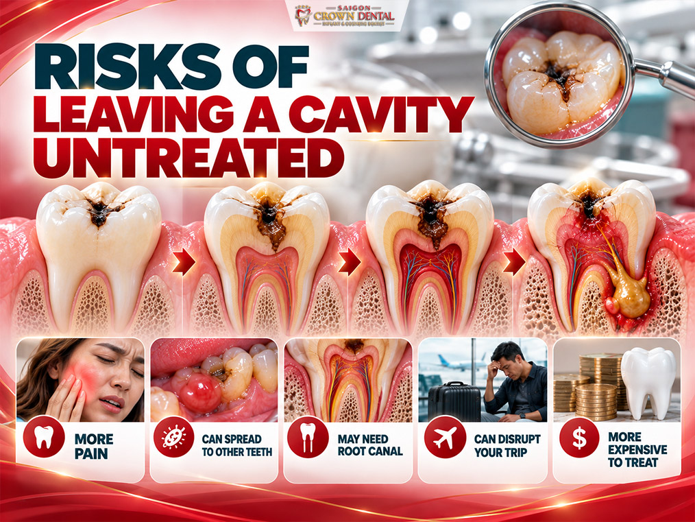 Risks of Leaving a Cavity Untreated