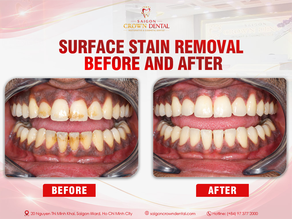 Teeth Cleaning Before and After