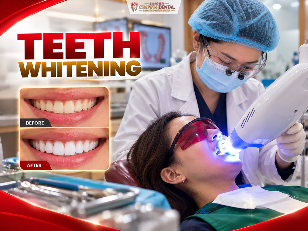 Teeth Whitening