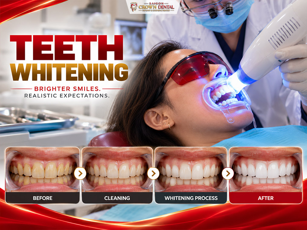 Teeth Whitening Results