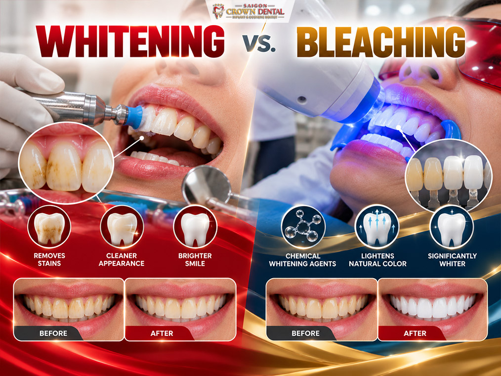 Teeth Whitening vs Bleaching