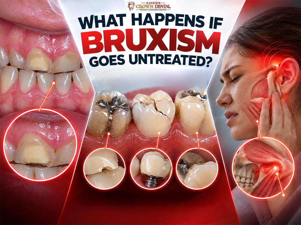 untreated bruxism damage