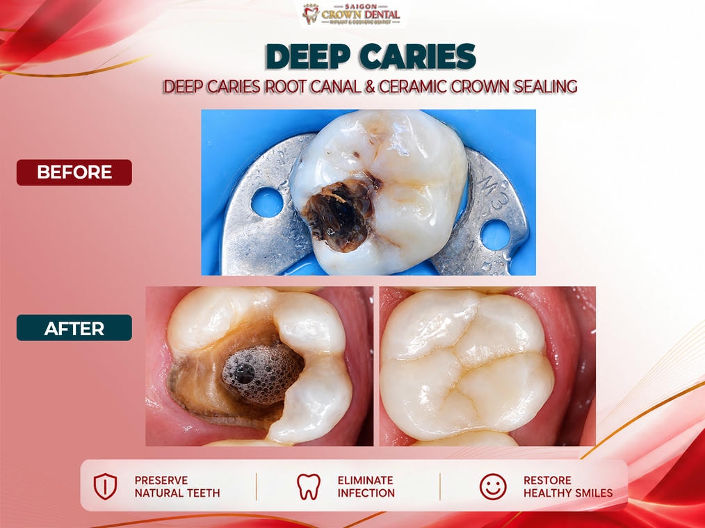Điều trị tủy trước và sau