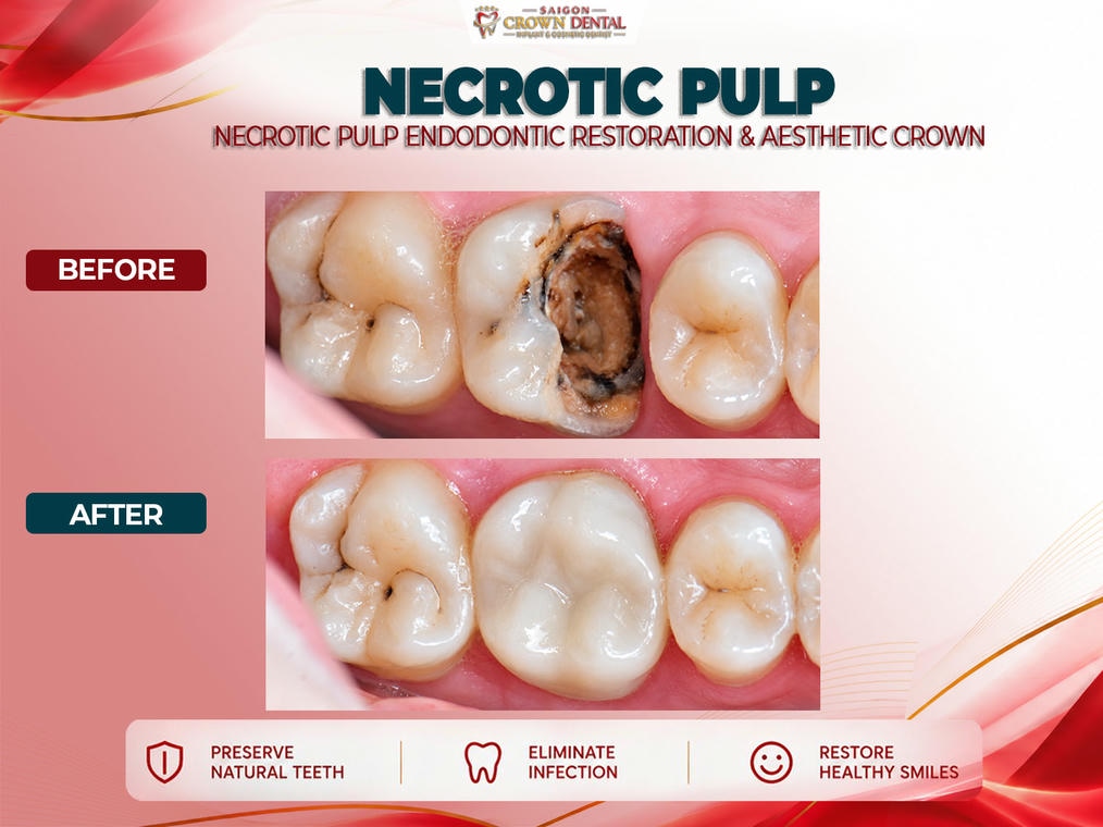 Điều trị tủy trước và sau