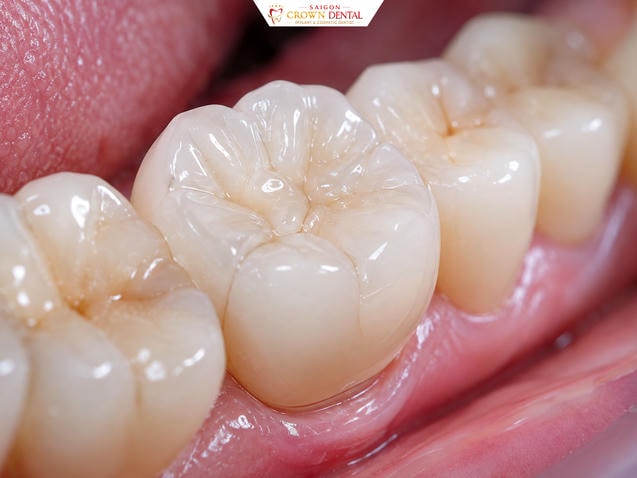 Vật liệu sứ cao cấp