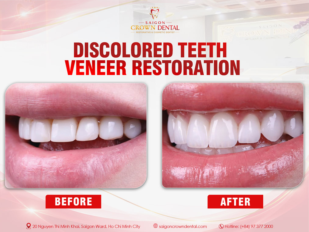 Veneer cho răng nhiễm màu nhẹ – Nha khoa Sài Gòn Crown