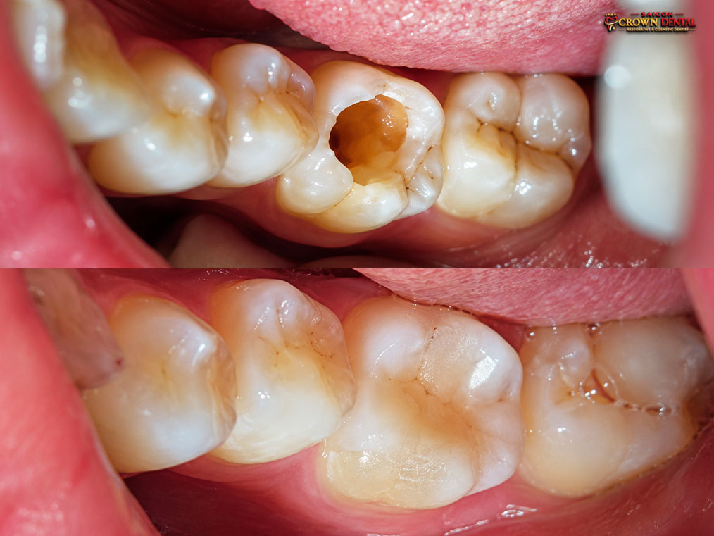 Molar cavity composite filling before after by Dr. Nguyen Thi Yen Nhi