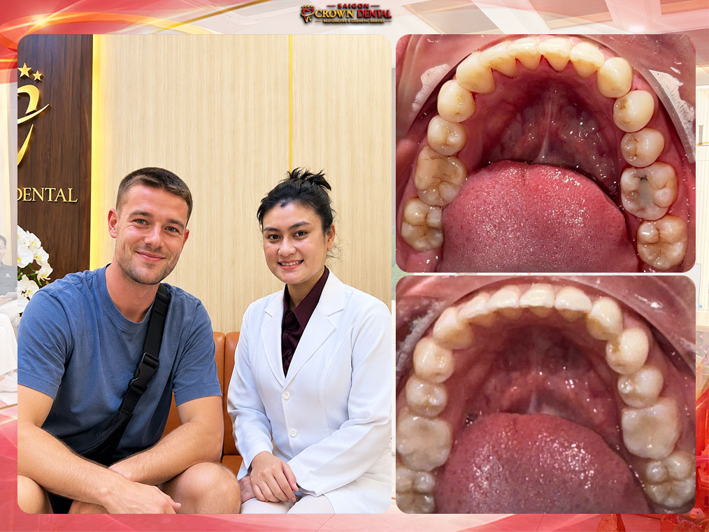 Trám răng hàm composite trước và sau bởi BS Nhi
