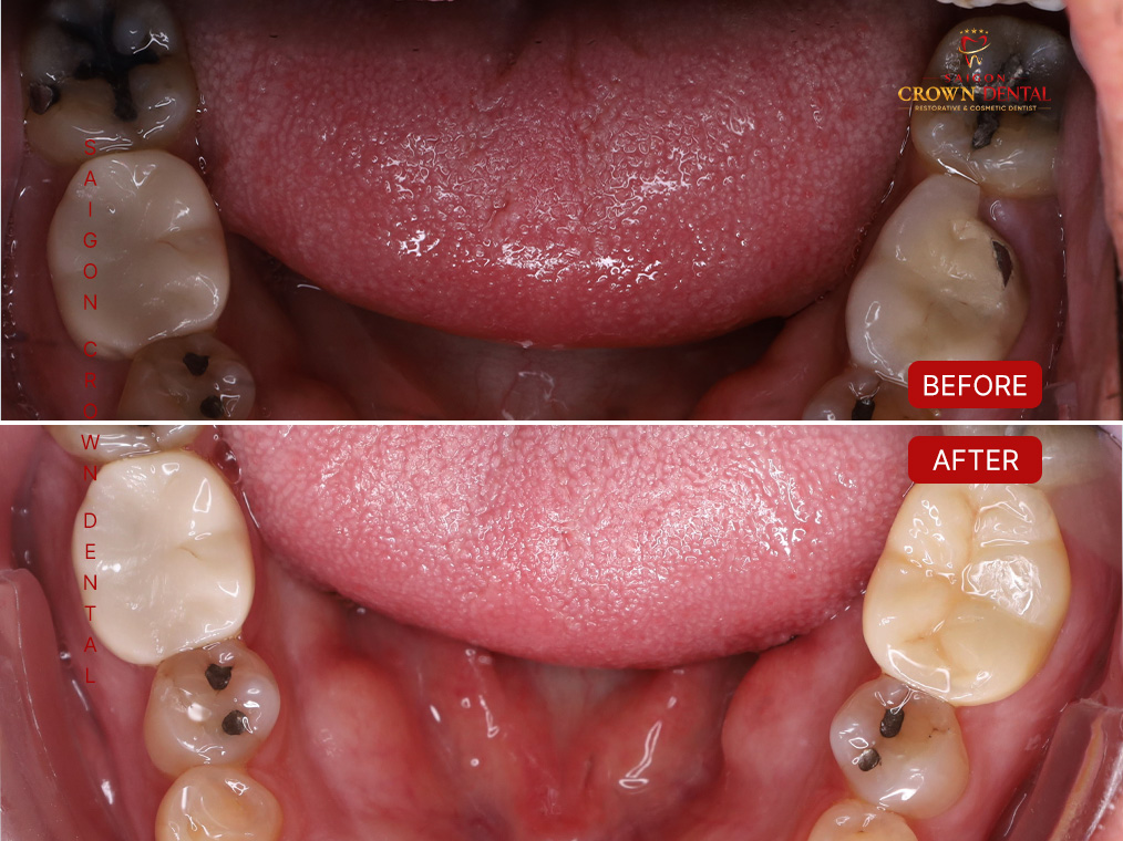 Lower arch molar restorations before after by Dr. Nguyen Thi Yen Nhi