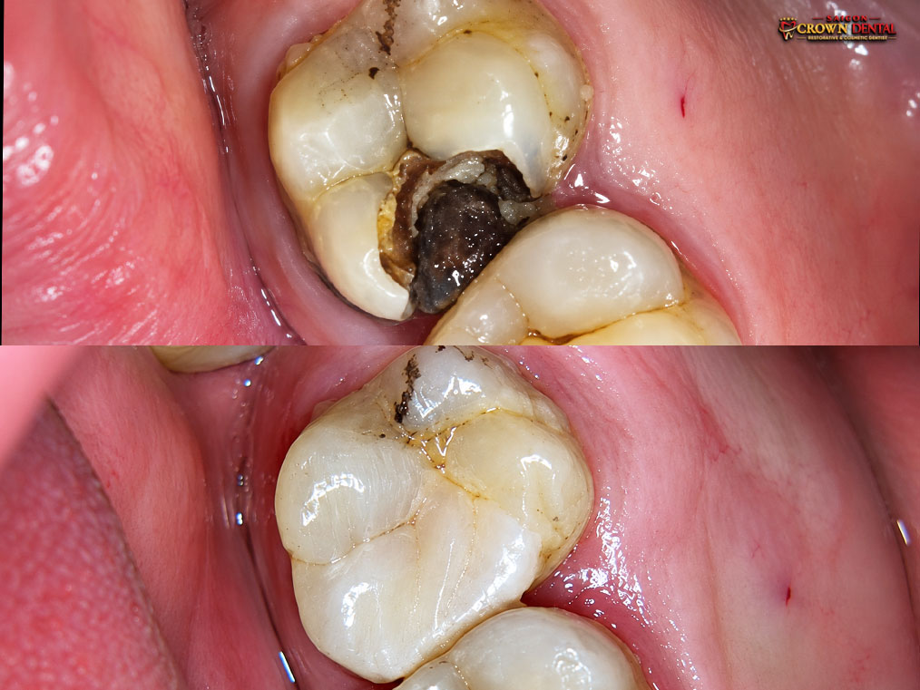 Decayed molar tooth restoration before after by Dr. Nguyen Thi Yen Nhi