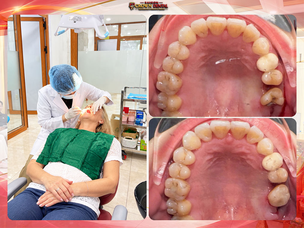 Upper Molar Tooth Restoration