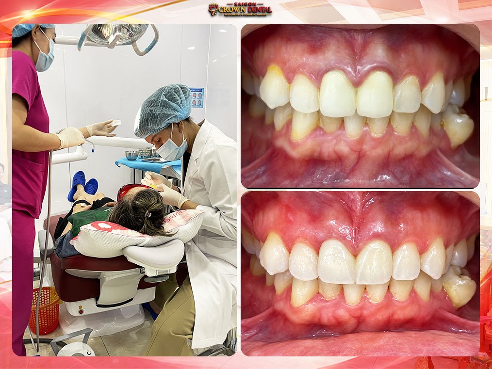 Anterior Porcelain Veneers Before and After