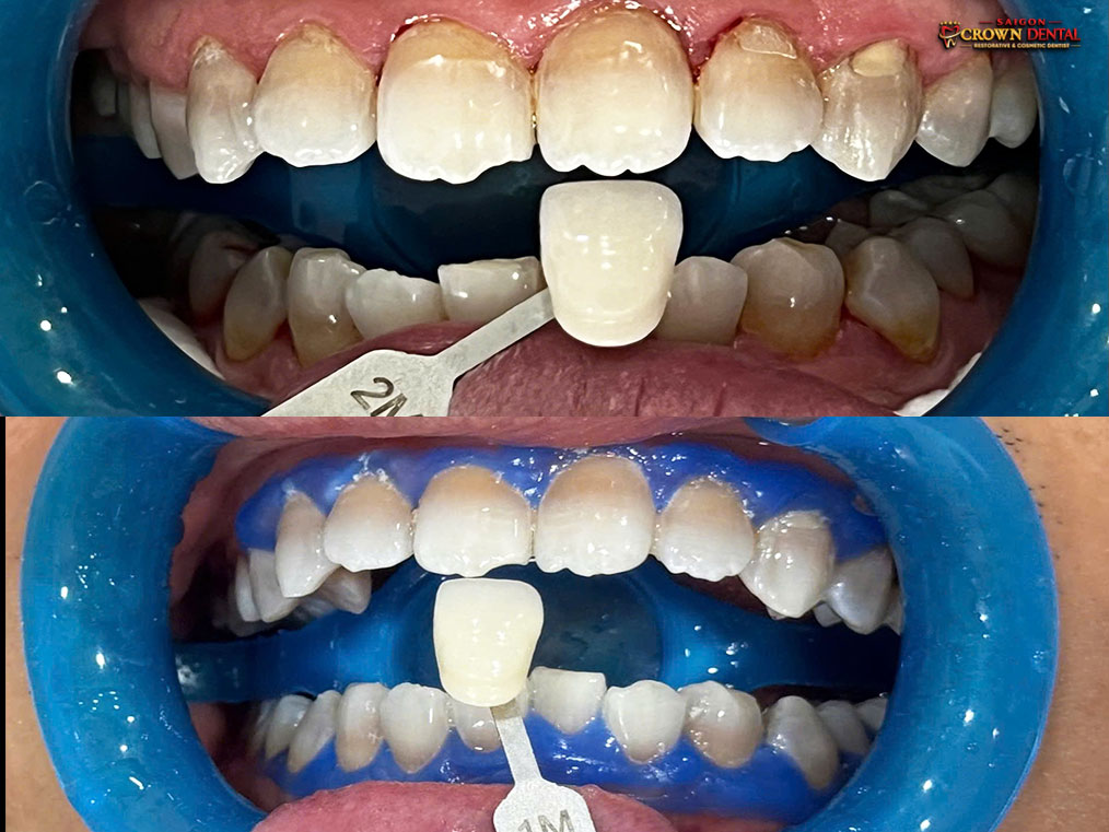 Professional teeth whitening before after with shade guide