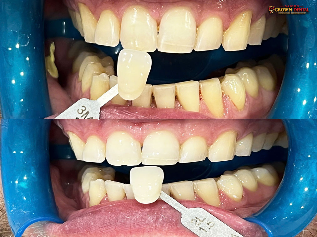 Teeth whitening result before after by Dr. Nguyen Thi Yen Nhi