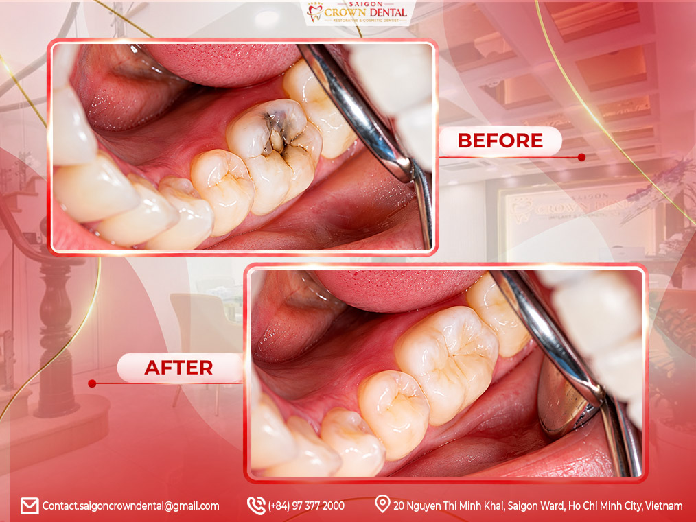 Inlays Onlays Before After in Saigon Crown Dental