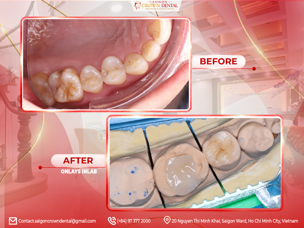 Inlays Onlays Before After in Saigon Crown Dental
