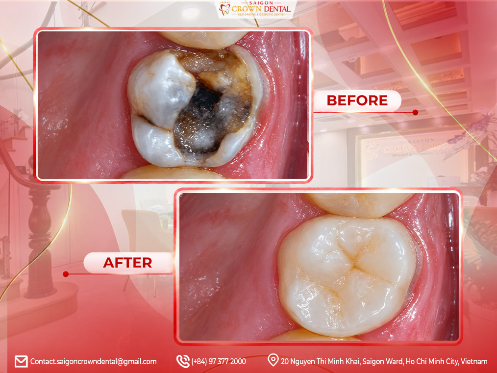 Inlays Onlays Before After in Saigon Crown Dental