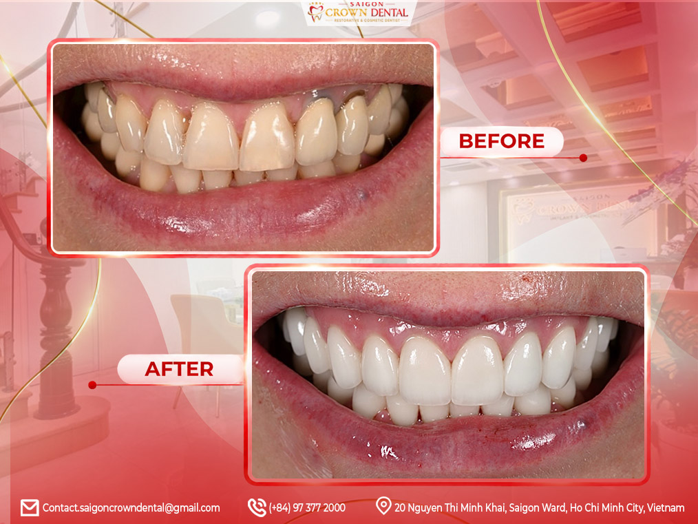 Dental Crown Before After in Saigon Crown Dental